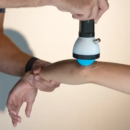 StemWave Therapy on Arm Service